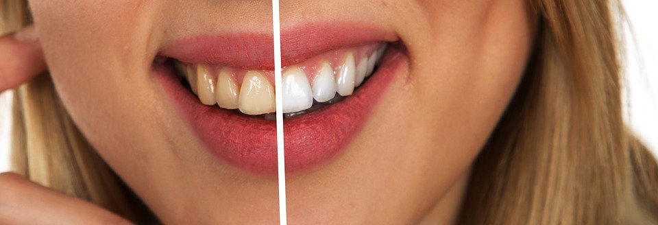 Tips for the Best Home Bleaching – White Teeth