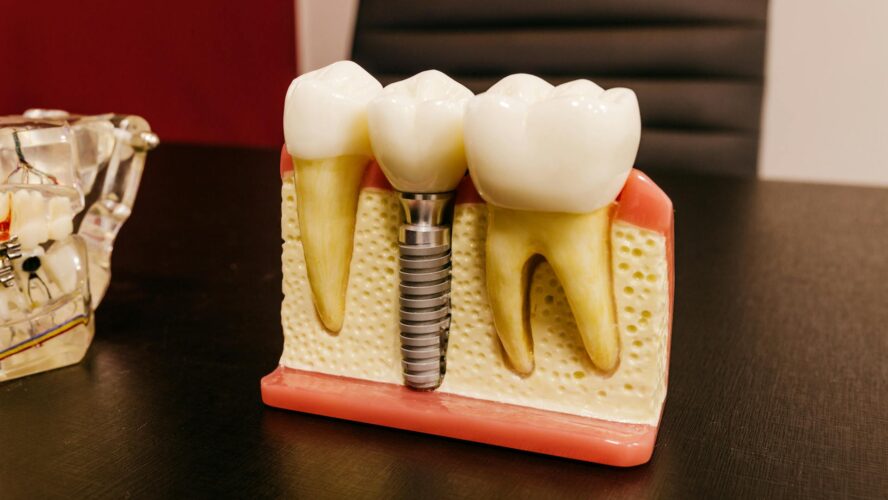 Dental Implants and Bone Health: How They Prevent Jaw Deterioration