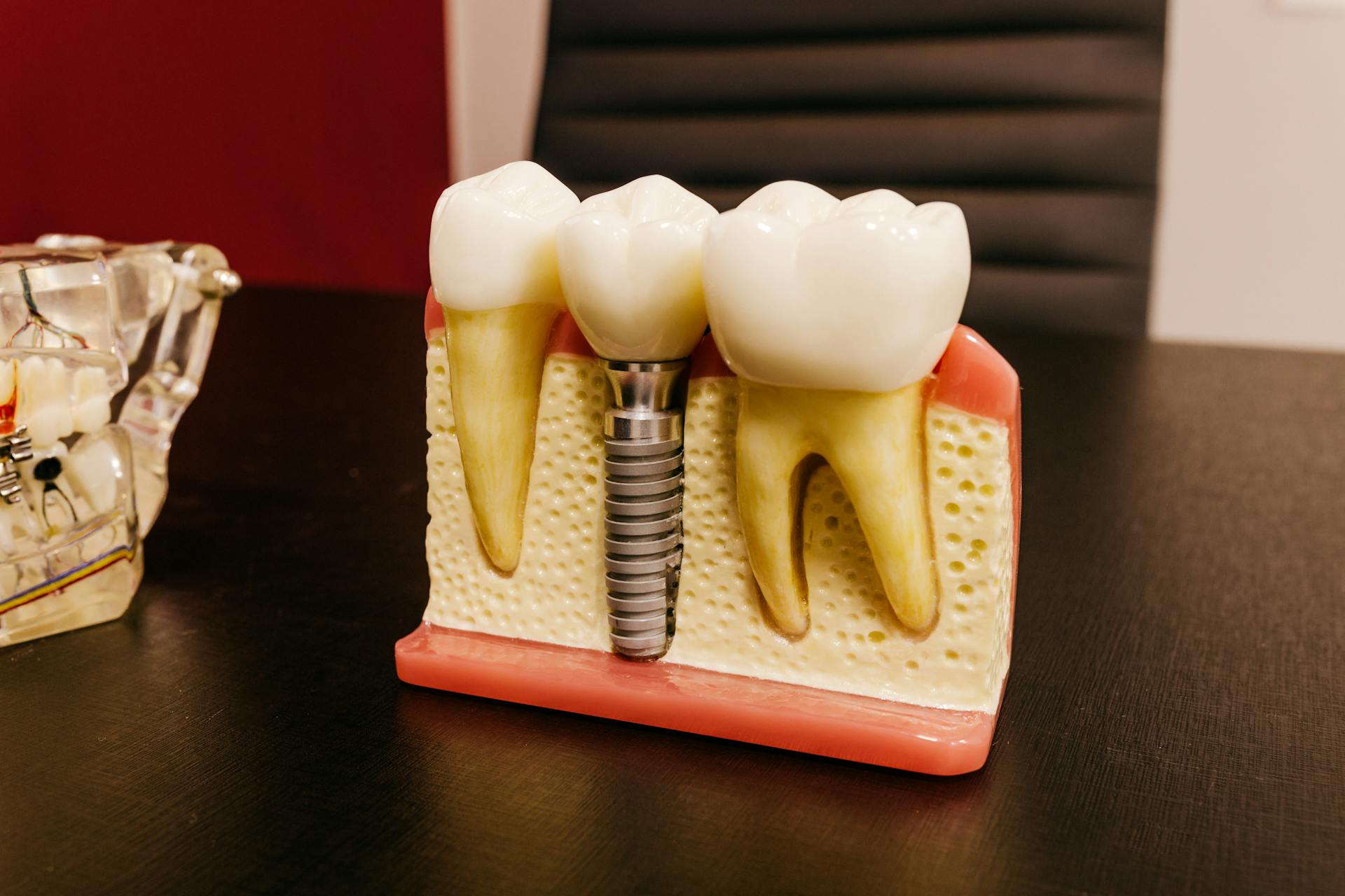 Dental Implants and Bone Health: How They Prevent Jaw Deterioration